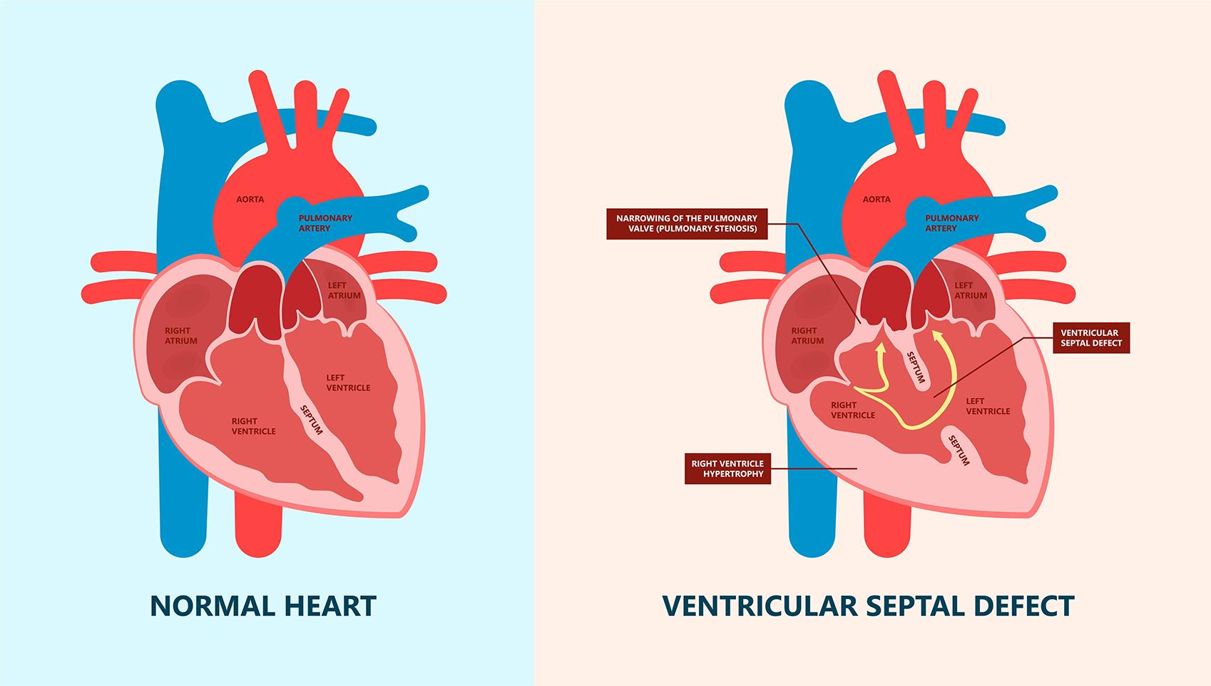 Ventricular Septal Defect (VSD) Treatment: Options, Procedures, and Recovery